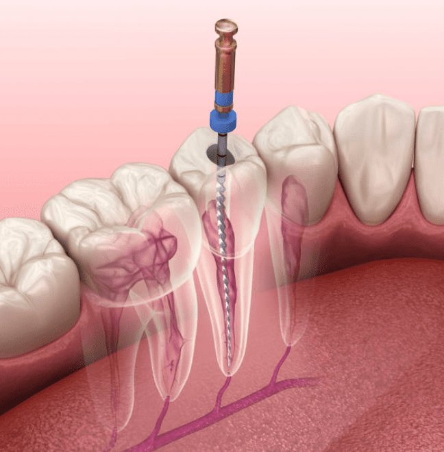 Endodontie (dévitalisation)