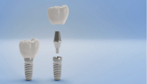 'hygiène post-chirurgicale suite à la pose d'un implant dentaire